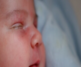 عمش العين عند الرضع