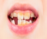 تغير لون أسنان الطفل: الأسباب وأهم النصائح