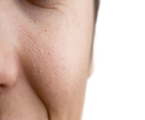 علاج الحبوب البيضاء الصغيرة في الوجه