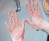 علاج حساسية اليدين من الصابون