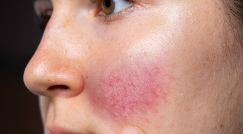 علاج حرقان الوجه واحمراره