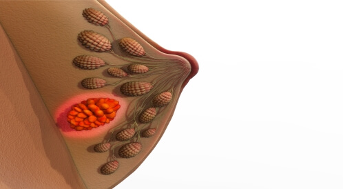 أعراض التهاب الغدد الليمفاوية في الثدي