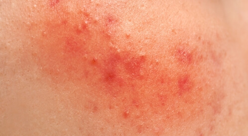علاج تهيج الجلد من المبيدات