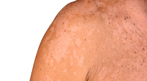 علاج التينيا بالليمون: هل هو ممكن؟