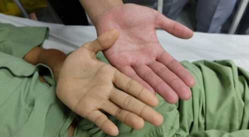 اصفرار اليدين: الأسباب وطرق العلاج