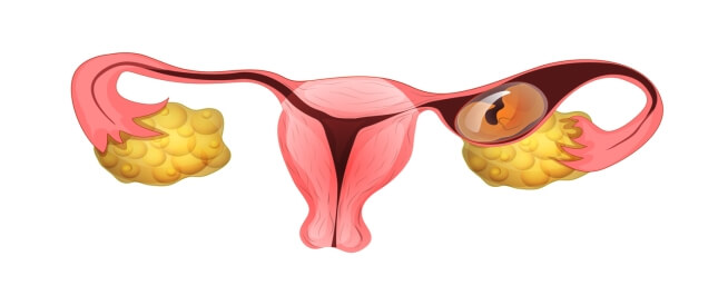 عملية الحمل خارج الرحم