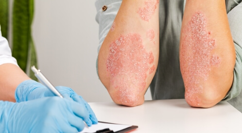 الحل النهائي لفطريات الجلد: حلول طبية ومنزلية