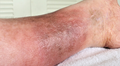 مرض الحمرة لمرضى السكر: تعرف عليه