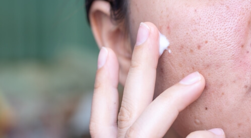 علاج آثار الحبوب والبقع السوداء: طرق طبية، ووصفات طبيعية