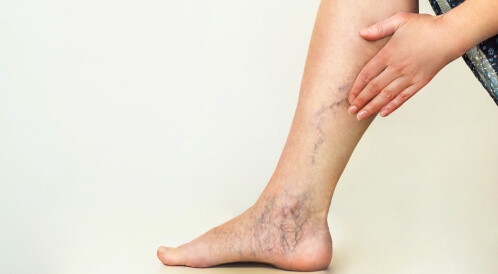 ظهور عروق زرقاء في القدم: دليلك الشامل