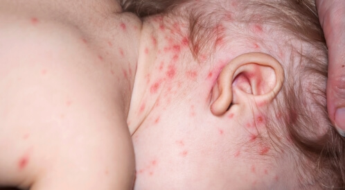 حبوب صغيرة في رقبة طفلي: الأسباب وطرق العلاج