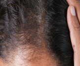 علاج قشرة الشعر الفطرية طبيًا وبطرق أخرى