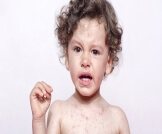 علاج حساسية الجلد عند الأطفال في المنزل