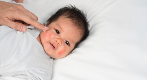 حبوب حمراء في وجه الرضيع: الأسباب والعلاج