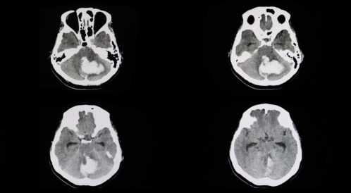 جلطة المخيخ: دليلك الشامل
