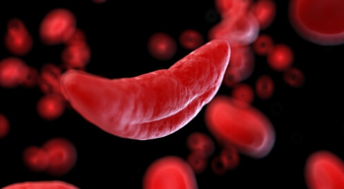 درجات فقر الدم المنجلي