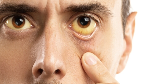 أعراض الكبد على الوجه: تعرف عليها