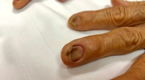 تقعر الأظافر (الأظافر الملعقية): هل ظاهرة دائمة أم مؤقتة؟