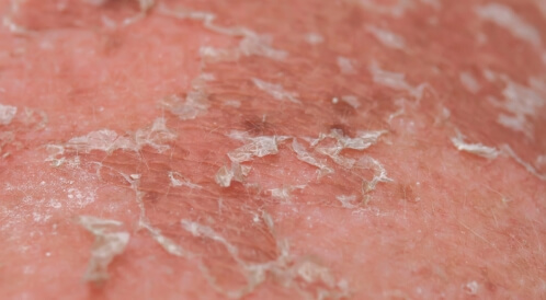 تقشر الجلد بعد الحرق: أبرز المعلومات