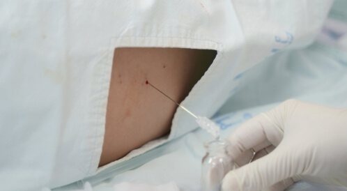 خزعة الظهر: كل ما يهمك معرفته