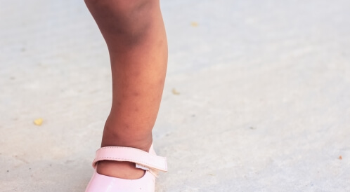 علاج لين العظام عند الأطفال