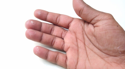 تقشر جلد الأصابع