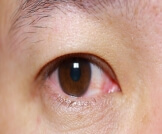 العين القرنفلية: احمرار في العين متعدد الأسباب