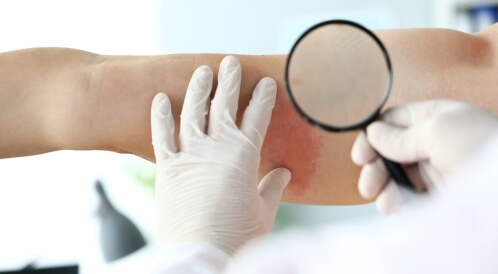 أسرع طريقة لعلاج الحزام الناري