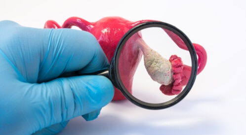 علاج الكيس على المبيض: معلومات هامة