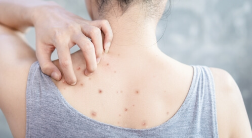 حبوب الظهر عند النساء: كل ما يهمك