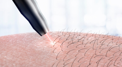 أضرار الليزر للمنطقة الحساسة: تعرفي عليها