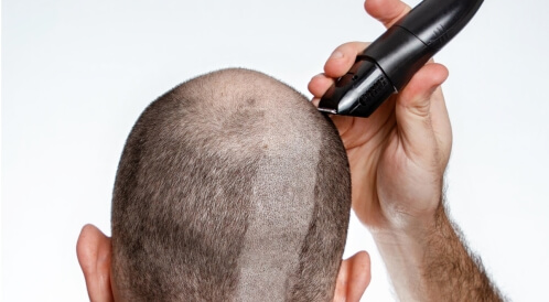 هل حلق الشعر يزيد من كثافته؟