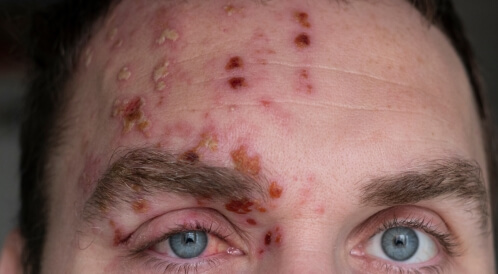 الحزام الناري في العين: دليلك الشامل