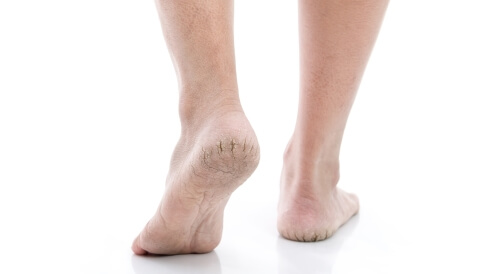 أسباب تشقق القدمين في الصيف