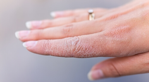 أسباب تشقق اليدين