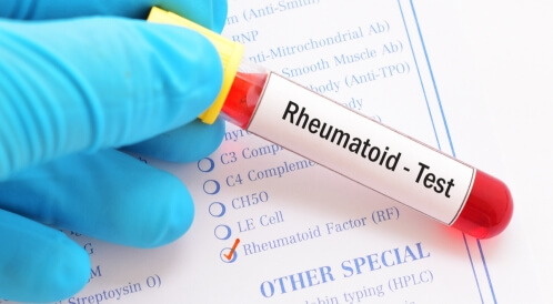 نسبة الروماتويد الطبيعية: تعرف عليها