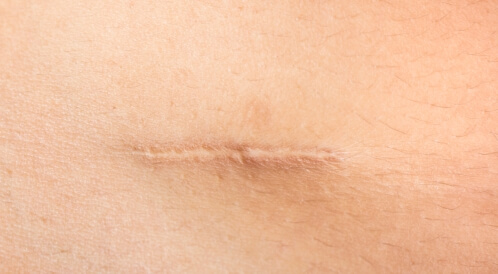 إزالة آثار العمليات الجراحية القديمة: طبيًا وطبيعيًا