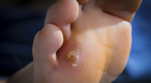 أنواع مسمار القدم: تعرف عليها