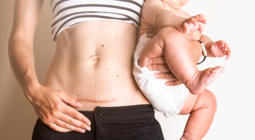 متى يلتئم جرح الخياطة بعد الولادة؟