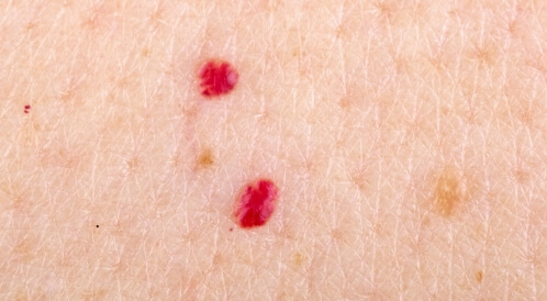 ورم وعائي كرزي: هل يستدعي القلق؟