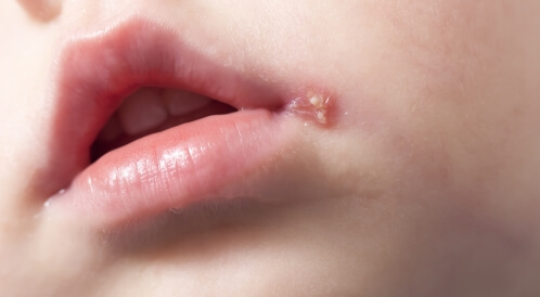 مرض الهربس للأطفال: معلومات هامة