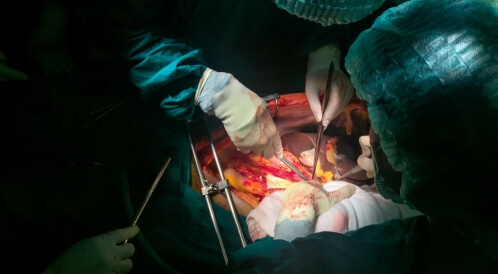 عملية تبديل شرايين القلب: دليلك الشامل