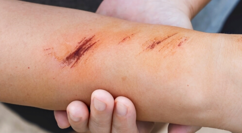 أنواع جروح السكري: تعرف عليها