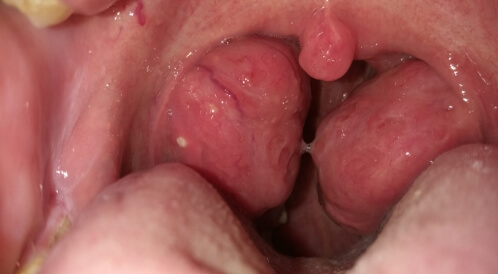 هل تضخم اللوزتين خطير أم لا؟