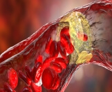 أعراض ضيق الأوعية الدموية الطرفية