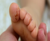 علاج تشقق أصابع القدمين عند الأطفال