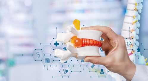 أنواع الانزلاق الغضروفي: تعرف عليها