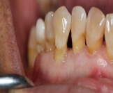 أسباب نزول اللثة عن الأسنان