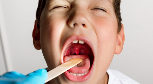 تضخم اللوزتين عند الأطفال بدون حرارة