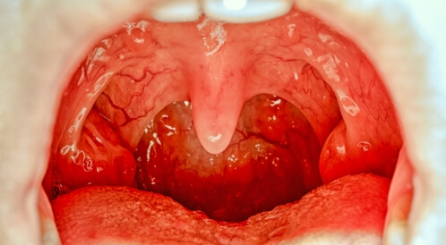 حجم اللوزتين الطبيعي